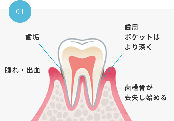 軽度歯周病スケーリングイメージ