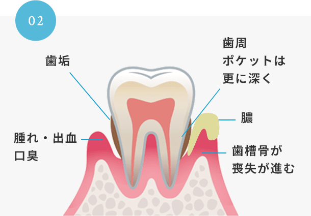 中度歯周病ルートプレーニングイメージ