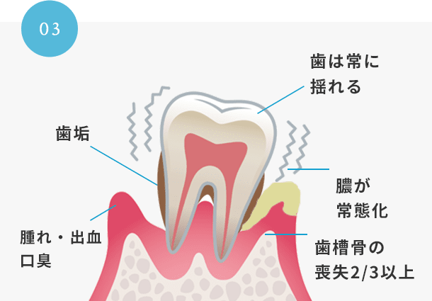 重度歯周病歯周外科治療イメージ