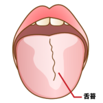 口腔内清掃不良による舌苔の様子