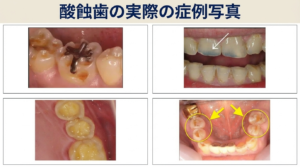 酸蝕歯の症例イメージ