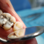 二次う蝕_イメージ