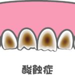 酸蝕歯