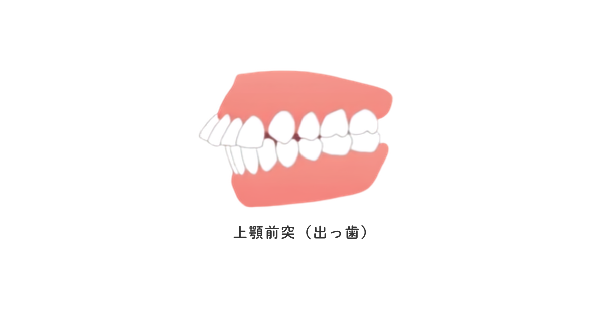 上顎前突