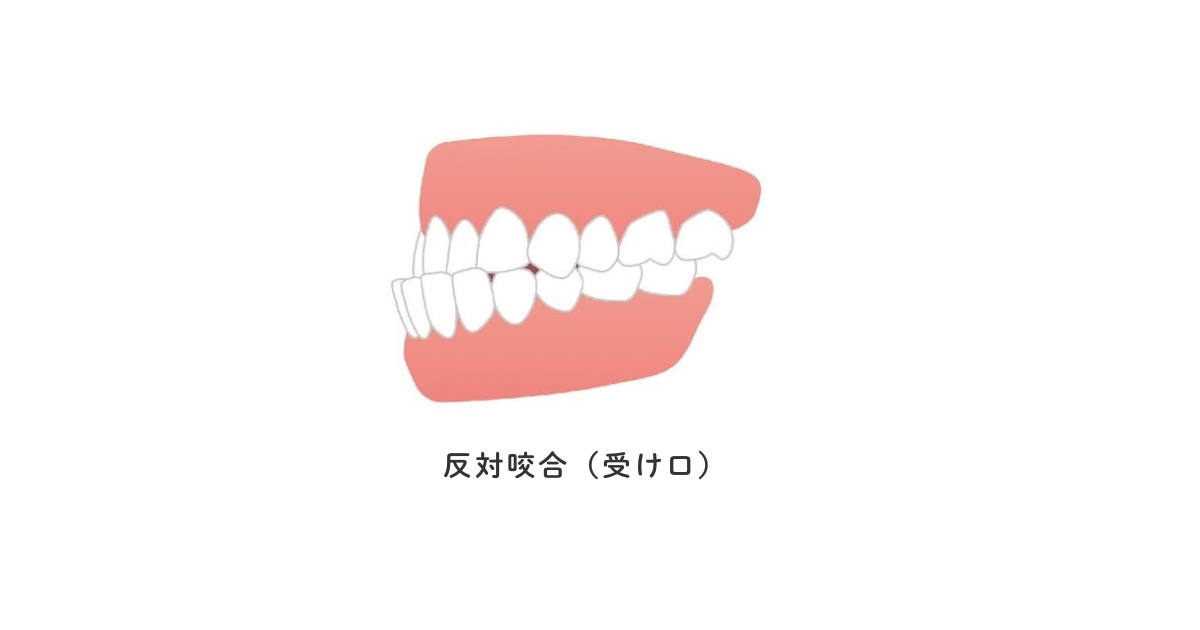 反対咬合(受け口)