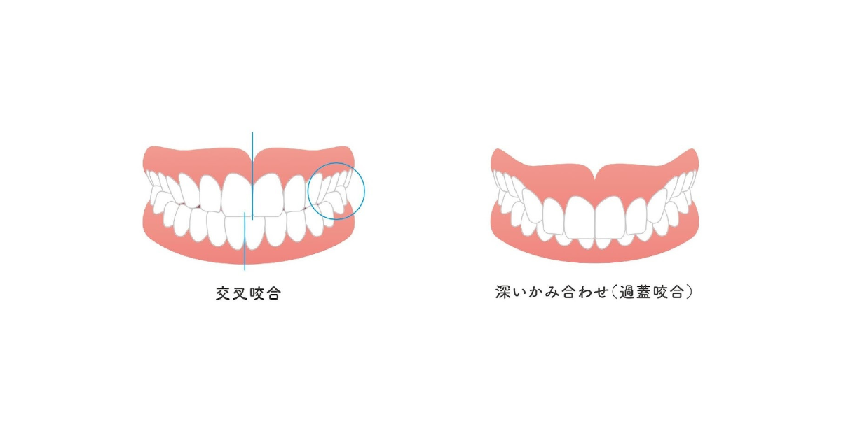 交叉咬合・過蓋咬合