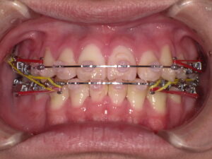 矯正歯科口腔内画像