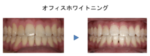 オフィスホワイトニング症例