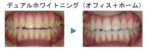 デュアルホワイトニング症例