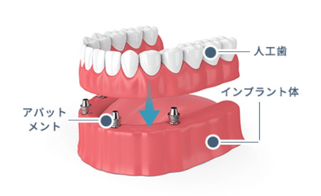 人工歯、インプラント体、アバットメント
