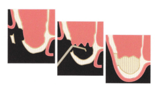 上顎洞,骨補てん材,シュナイダー膜,上顎の骨