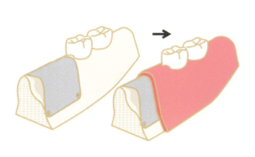 歯肉,人口膜,骨補てん材,骨