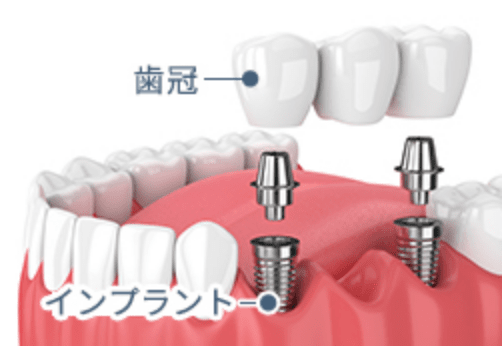 歯冠、インプラント