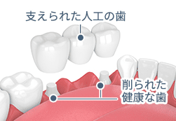 支えられた人口の歯、削られた健康な歯