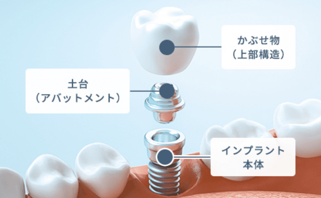 かぶせ物(上部構造)、土台(アバットメント)、インプラント本体