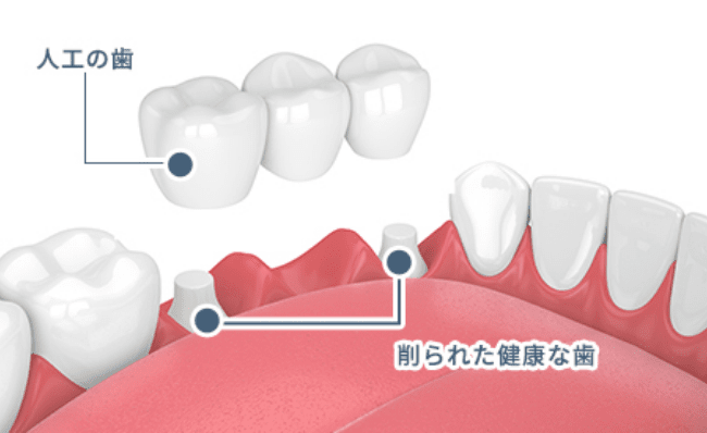 人口の歯、削られた健康な歯