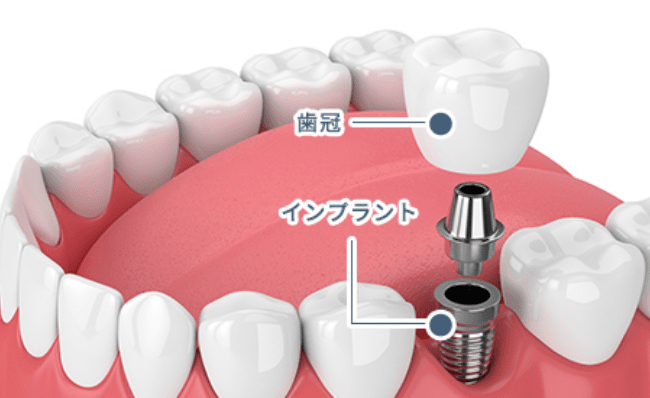歯冠、インプラント