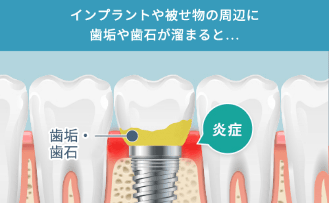 インプラントや被せ物の周辺に歯垢や歯石が溜まると…炎症